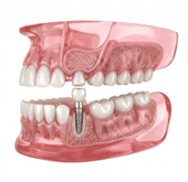 sinus-lifting